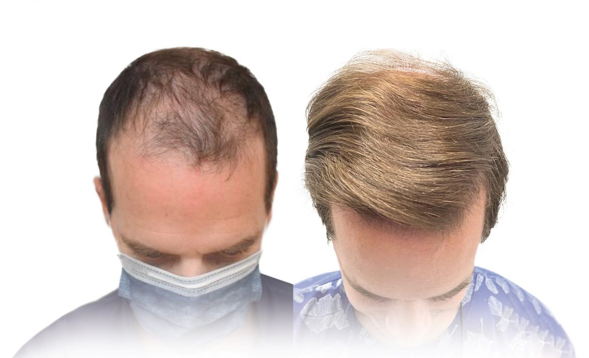 Hair Recovery llegó a General Pico